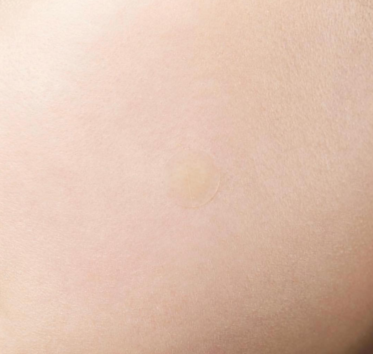 Parches para Acné Pimple Master Patch